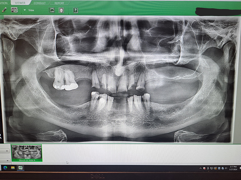 Akron Area Oral Maxillofacial   Facial Cosmetic Surgery Center | Corrective Jaw Surgery, Wisdom Teeth and Facial Injuries Reconstruction